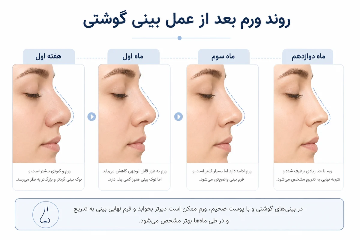 اینفوگرافیک روند تدریجی کاهش ورم پس از عمل بینی گوشتی
