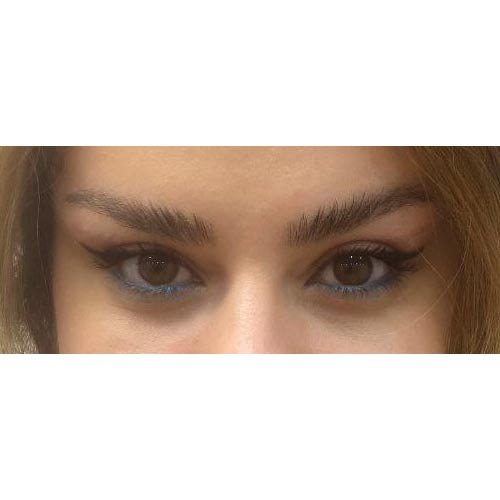 لیفت اندوسکوپیک پیشانی و شقیقه | تکنیک پیشرفته برای جوان‌سازی قسمت بالایی صورت