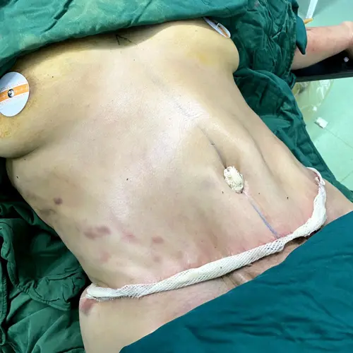 ابدومینوپلاستی