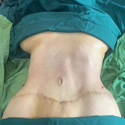 ابدومینوپلاستی چیست؟