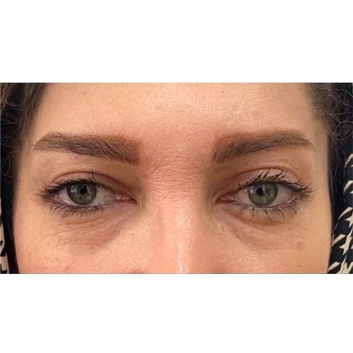 لیفت اندوسکوپیک پیشانی و شقیقه | تکنیک پیشرفته برای جوان‌سازی قسمت بالایی صورت