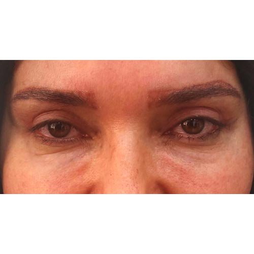 بلفاروپلاستی