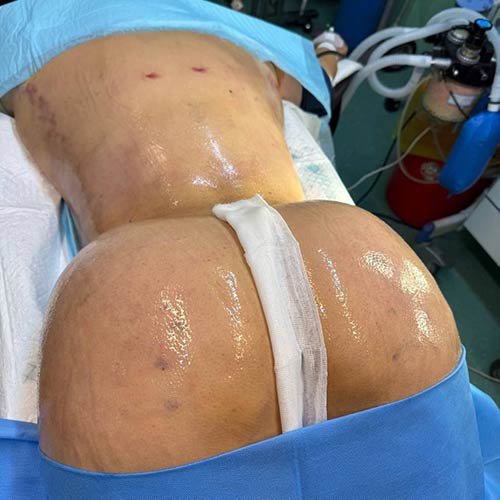 ابدومینوپلاستی همراه با لیپوترنسفر باسن