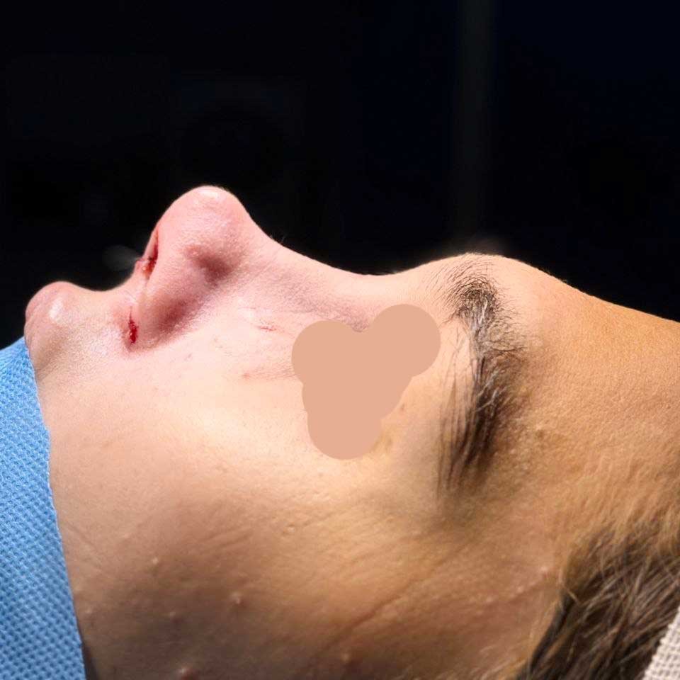 رینوپلاستی