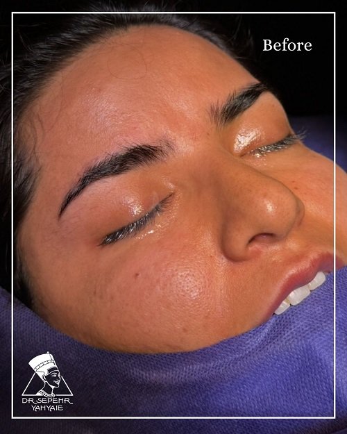 Before – 1 Before - 1